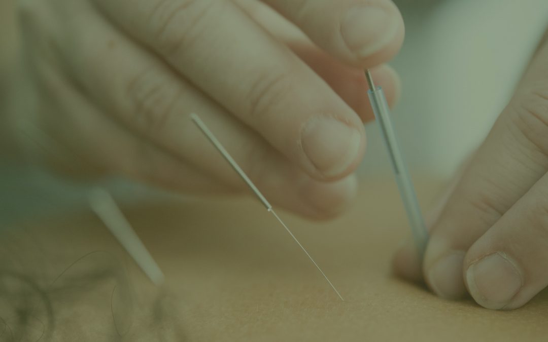 Dry Needling – Is it right for you!?